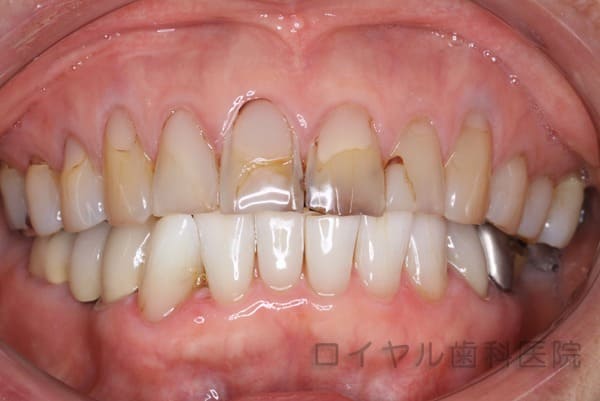 当院のホワイトニングの術前