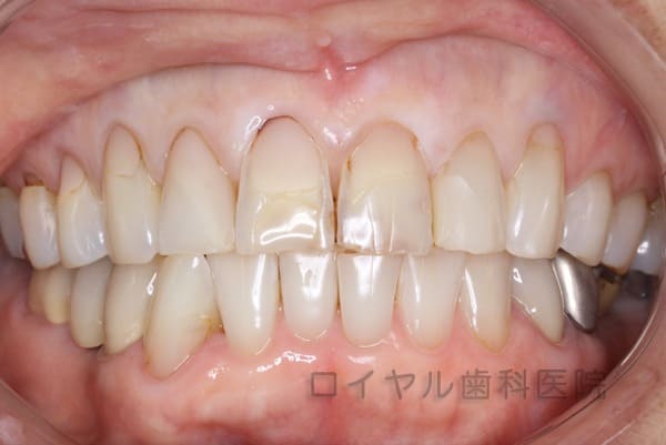 当院のホワイトニングの術後