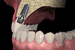 たまプラーザのロイヤル歯科医院のインプラント治療