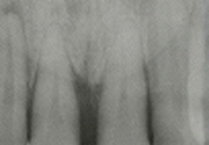 歯周炎由来による歯周膿瘍２
