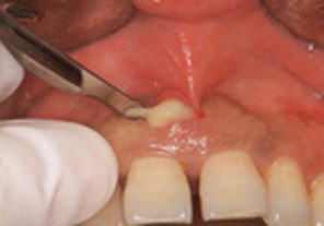 歯周炎由来による歯周膿瘍３